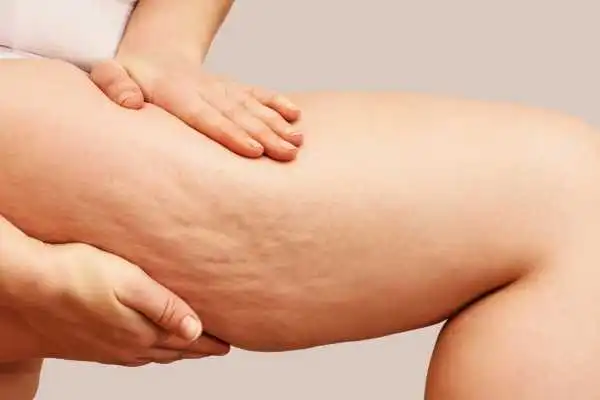 Image of woman showing leg with cellulite Irthlingborough