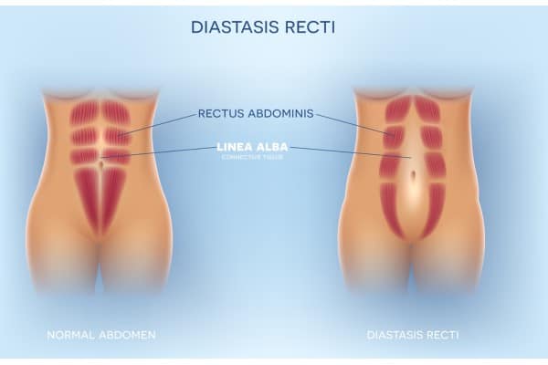 How Does Non-Surgical Treatment Help With Loose Skin, Weak Abdominal Muscles and Post-Pregnancy Changes Irthlingborough?