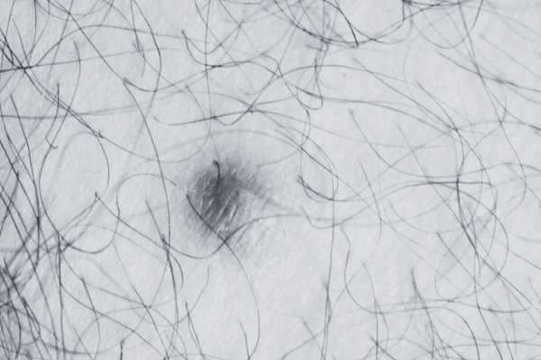 Dermatofibroma removal Irthlingborough made simple! Book in today!