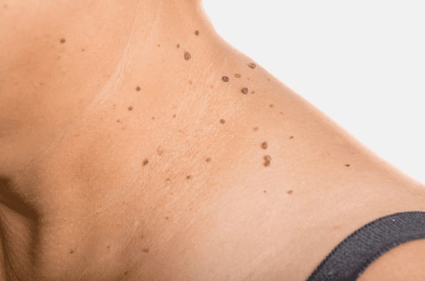 Are you looking for easy skin tag removal Irthlingborough - then contact Spire today!