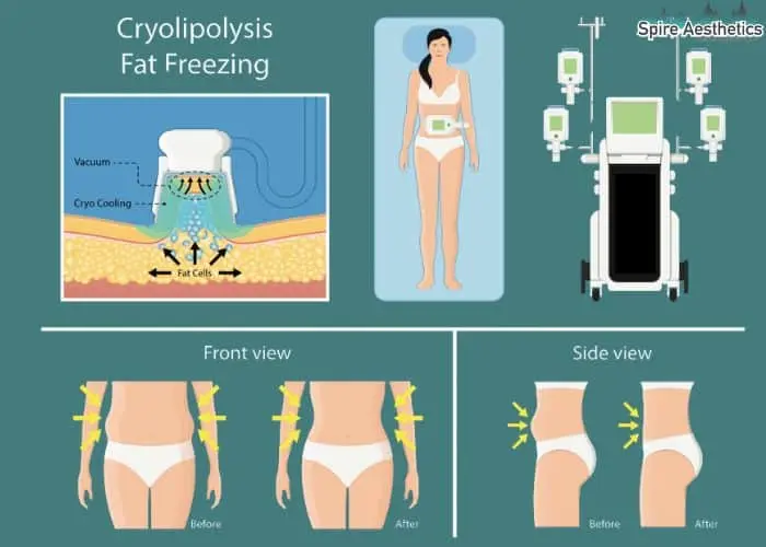 Fat freezing treatment Irthlingborough benefits for competitions to remove stubborn fat deposits.