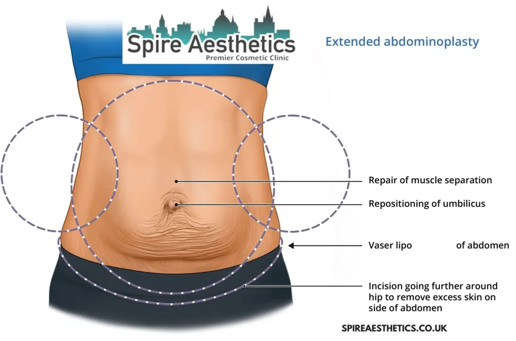 Understanding Loose Skin After Gastric Band Irthlingborough Surgery and HIFU Treatment