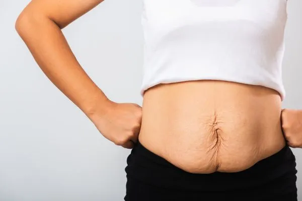 Image of a woman's stomach after weight loss with sagging skin following a gastric band Irthlingborough