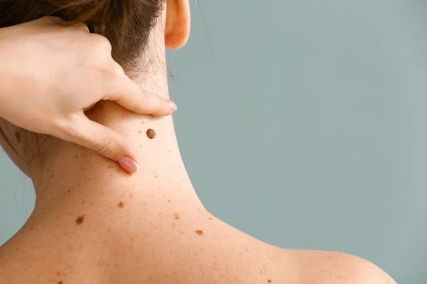 skin blemish removal Irthlingborough treatment