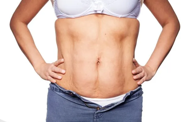 sagging skin on woman's stomach after weight loss injections Irthlingborough