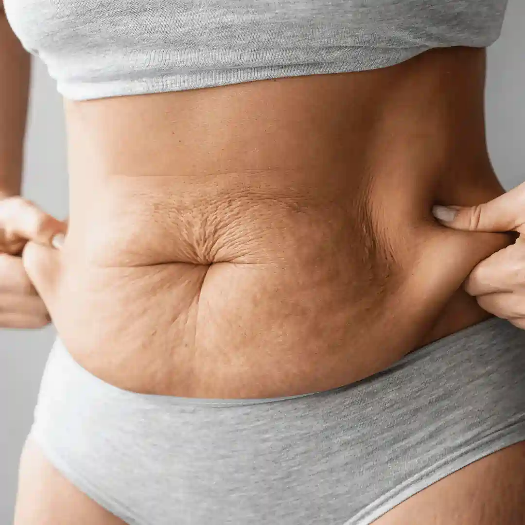 Is It Normal to Have Loose Skin After Pregnancy Irthlingborough?