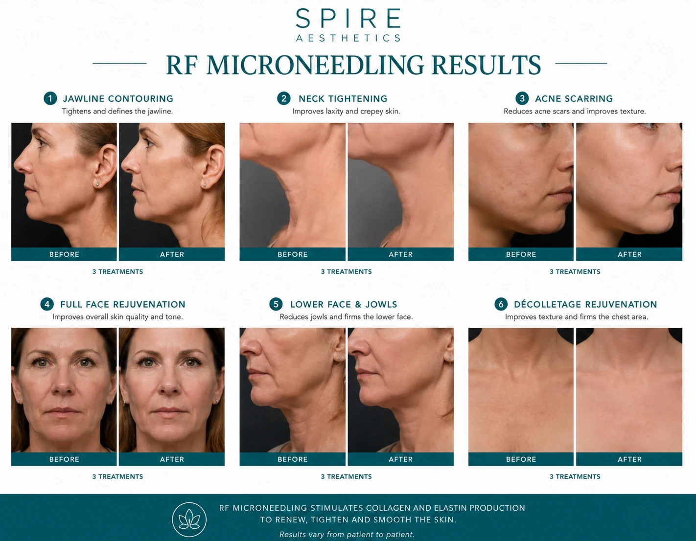 RF Microneedling Skin tightening Irthlingborough results