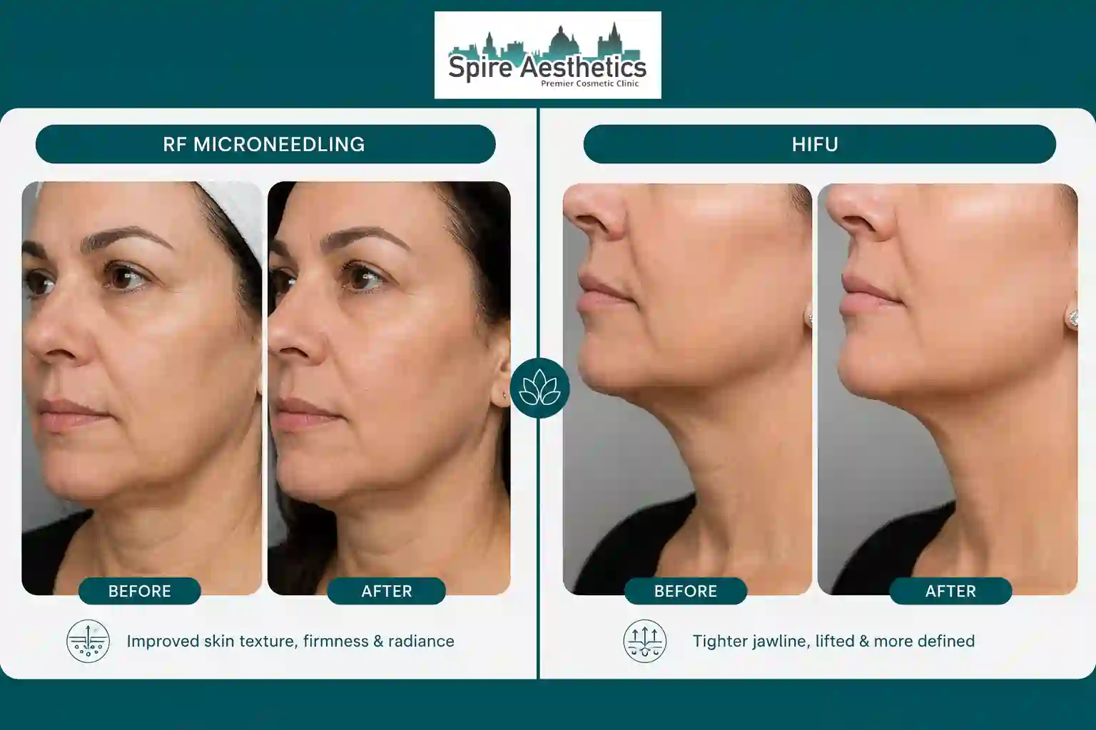 Can RF Microneedling and HIFU Be Combined Irthlingborough?