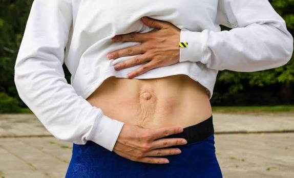 When Could Diastasis Recti Be the Missing Piece of the Puzzle Irthlingborough?