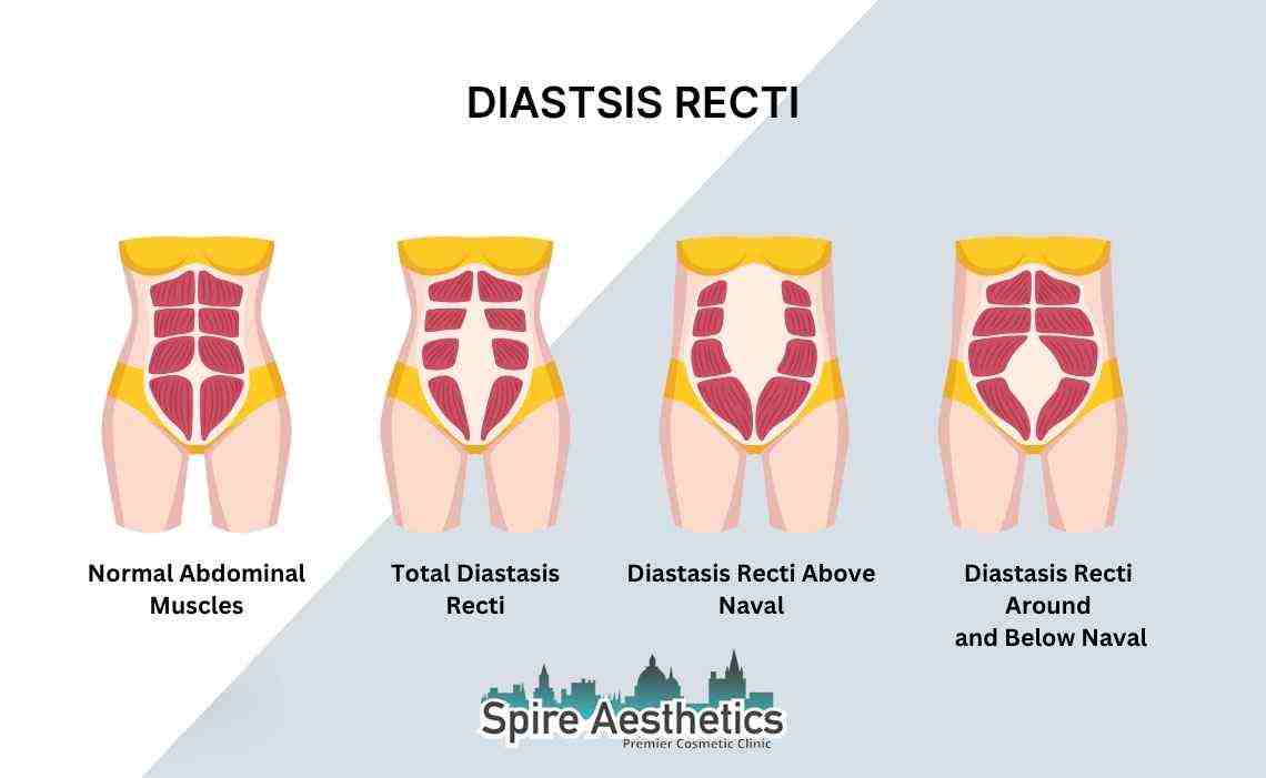 Is Non-Surgical Diastasis Recti Treatment Right for You? Common Concerns Answered Irthlingborough
